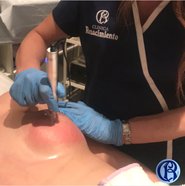 Eliminando estrías del pecho con Dermapunt Eliminando estrías del pecho con Dermapunt