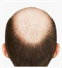 Are you suffering from Male Pattern Baldness(MPB)?  Did you try any of the following things / Solutions that surely works and permanent