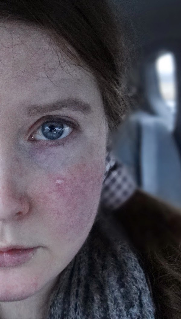 Scarlet Letters, dealing with vascular rosacea, face flushing, burning