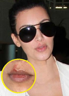 kimkardashian-herpessore.jpg