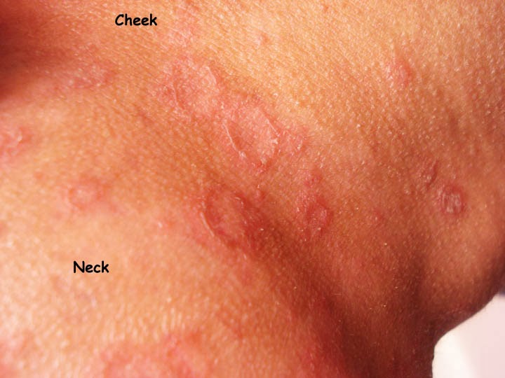 Arcuate Rash