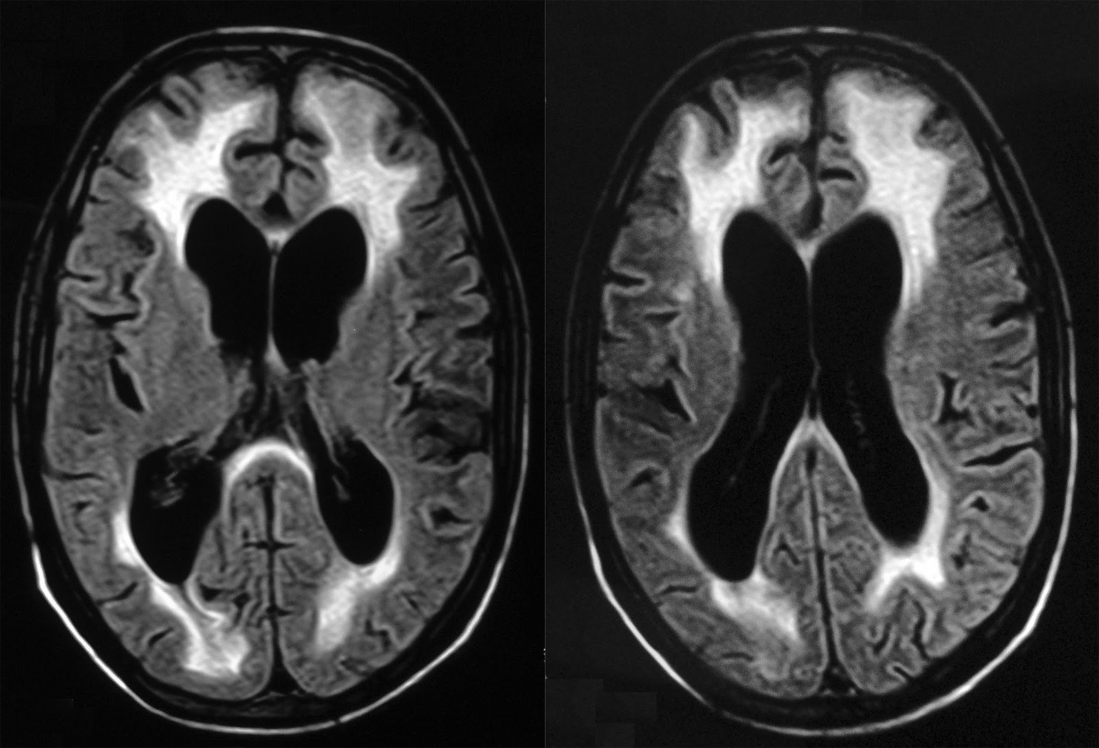 RADIOLOGY HIV Encephalopathy