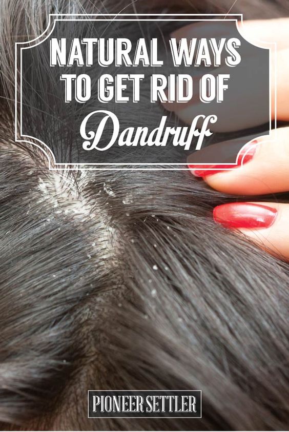 Natural Ways To Do Dandruff Treatment At Home TOP 5 DIY