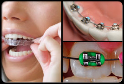Types de boîtiers dents