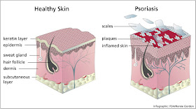 psoriasis gene mutation)