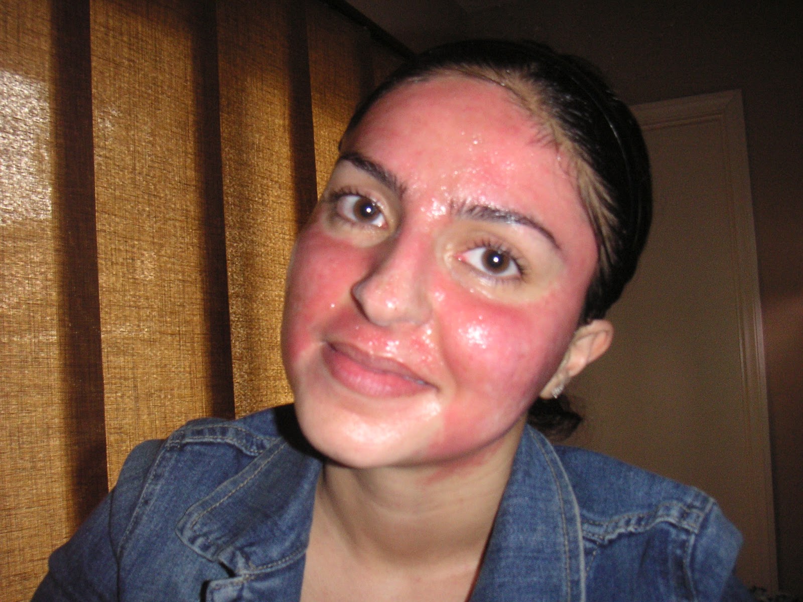 Burning Rash On Face