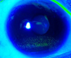 ojo seco queratitis