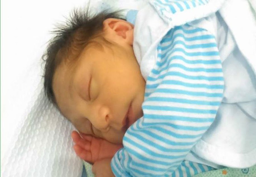 microcefalia por zika