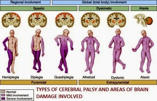 Types Of Cerebral Palsy