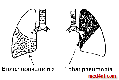 bronchopneumonia vs lobar pnumonia