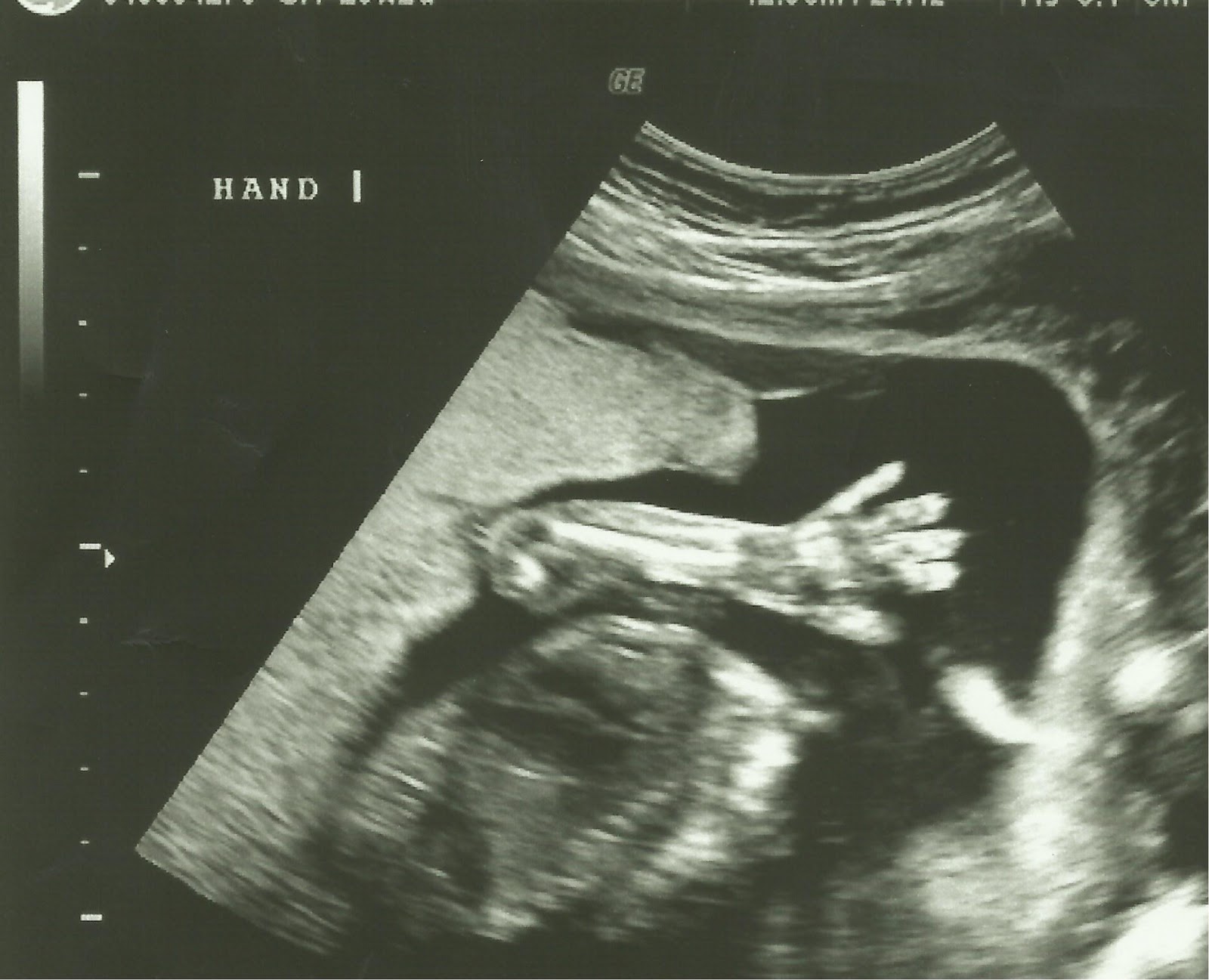 Discovering Your Own Stream ♥: 20 Week Ultrasound - Anatomy Scan