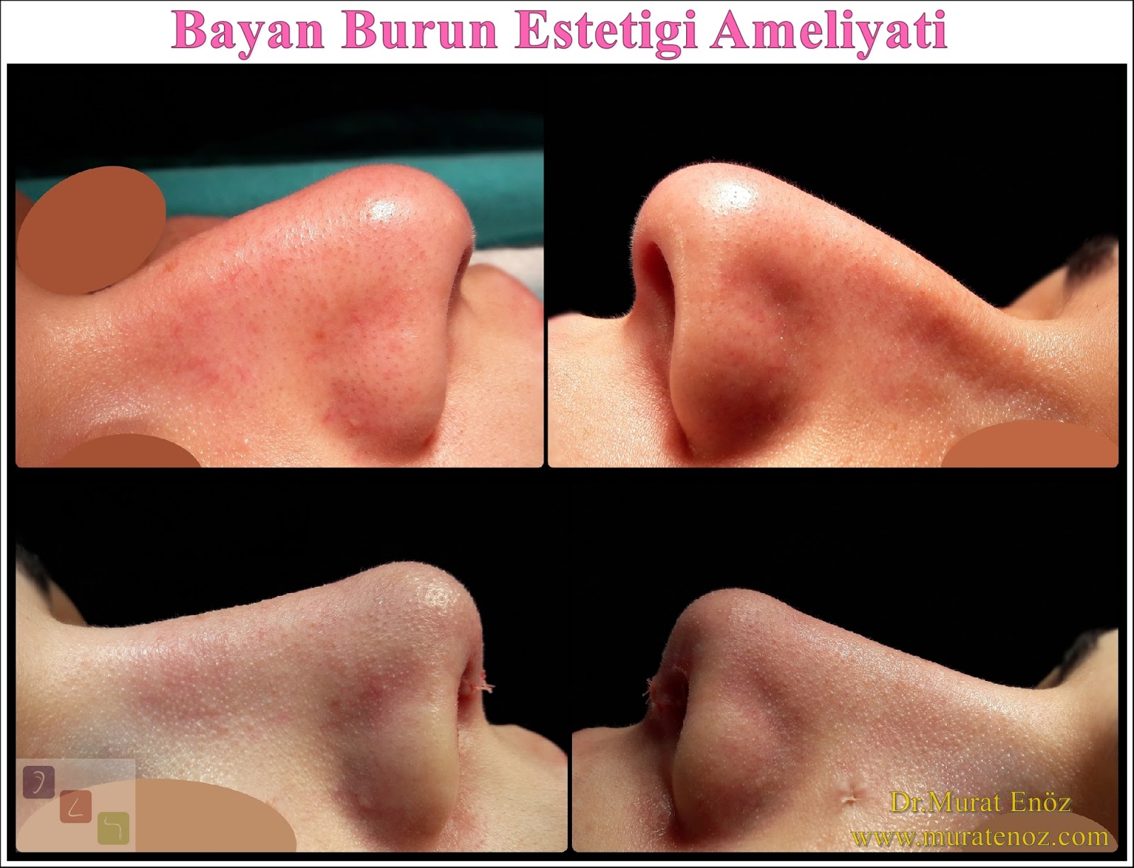 Bayan Burun Estetiği Ameliyatı