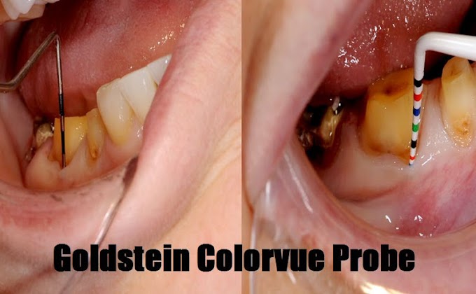 DENTAL INSTRUMENTS: Goldstein Colorvue Probe - Hu-Friedy