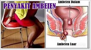 Obat Tradisional Ambeien Habis Melahirkan