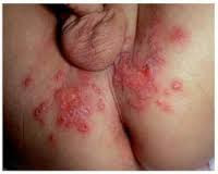 Obat jamur Selangkangan Obat jamur Selangkangan