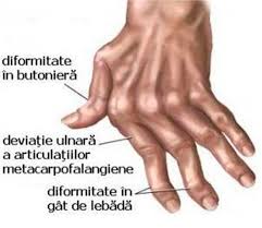 nursingul specific in artrita reumatoida