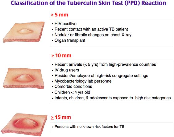 Interpretation Of PPD Skin Testing (Tuberculin)