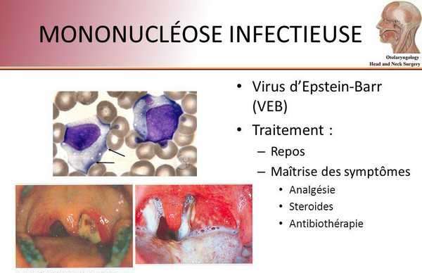 Cours  Mononucléose iNfectieuse