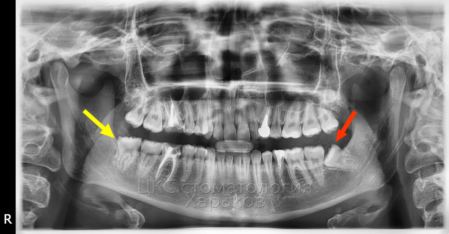 обязательно удалять зуб мудрости при брекетах