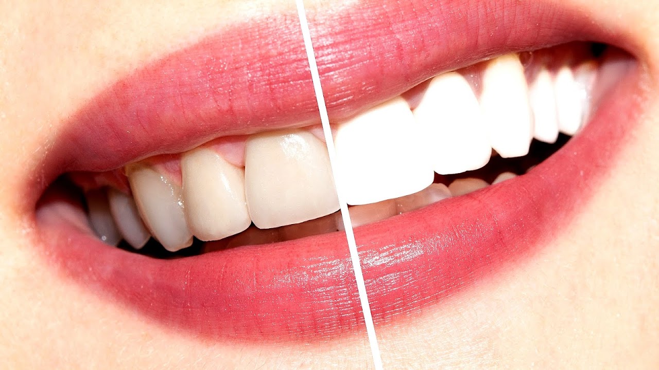 How Much Is It To Get Teeth Whitened At Dentist White Choices
