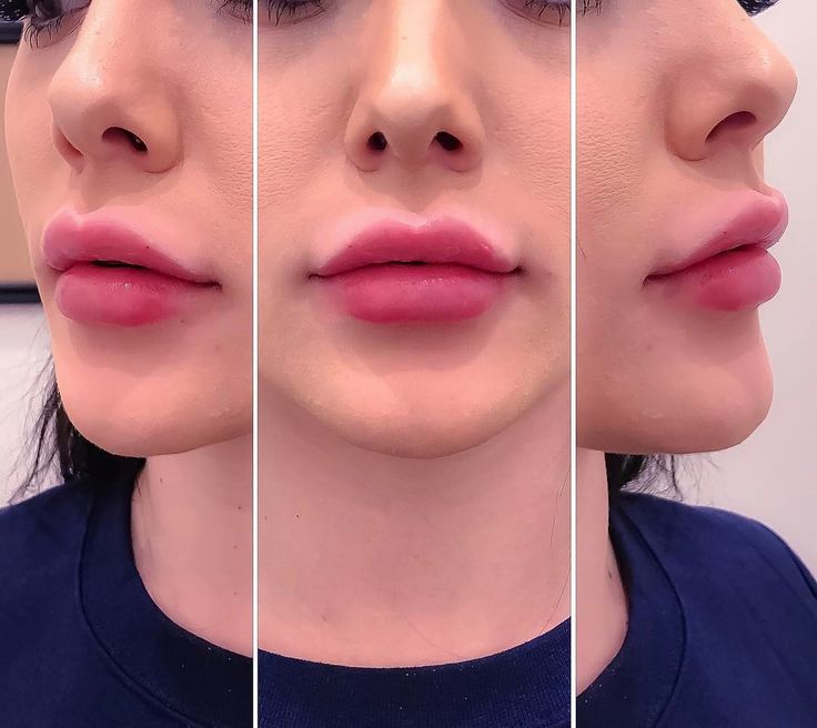 Cosmetic SkinCare Treatment 5 Things To Know About The Lip Enhancement