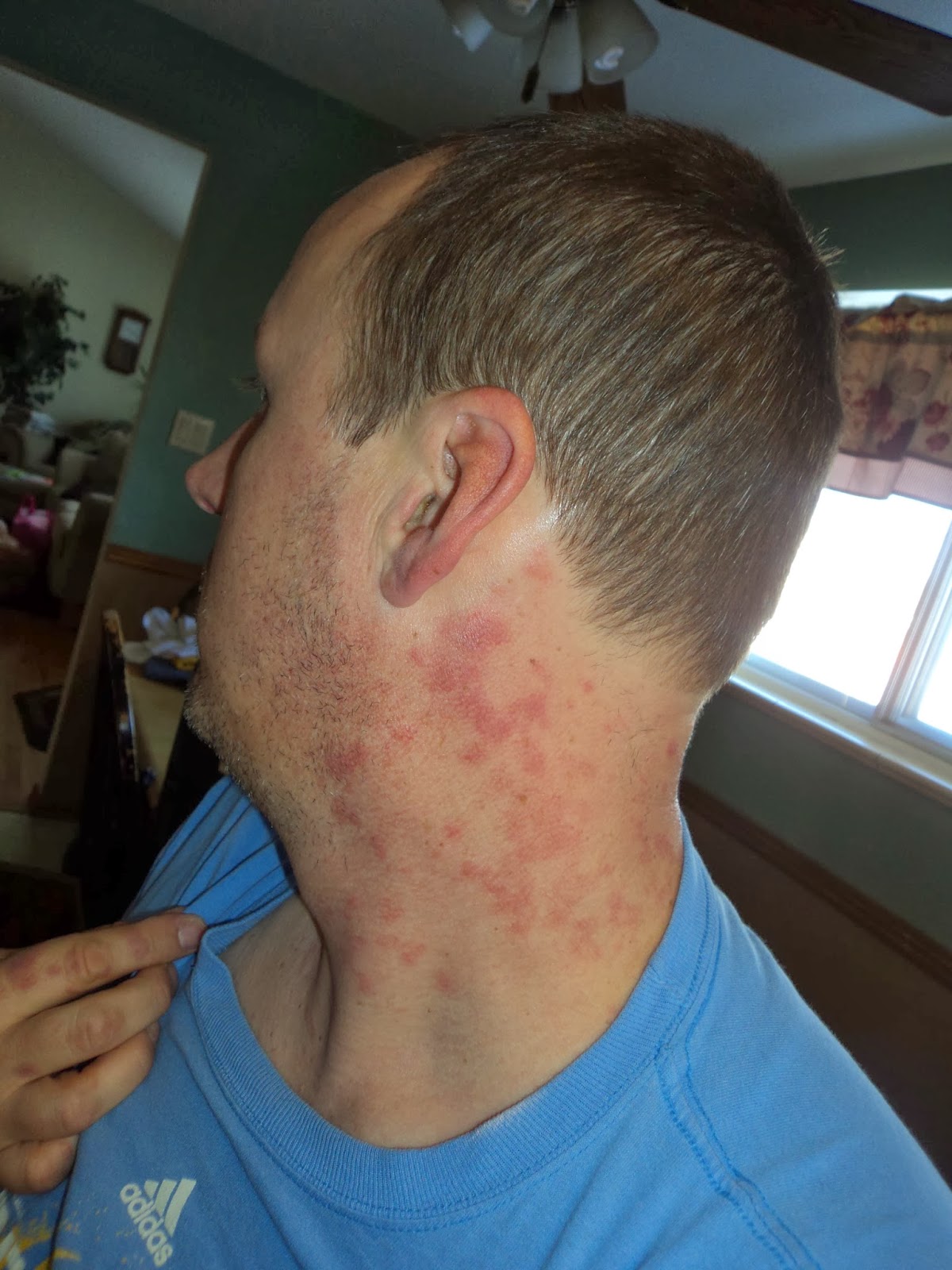 Rock and Roll Warrior: The rash and then some...