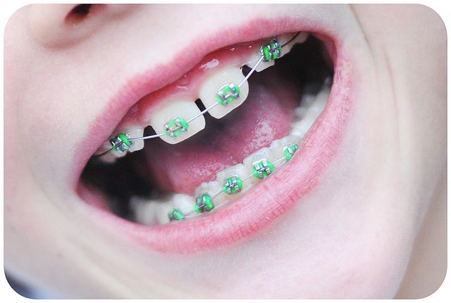 Брекеты на зубы для детей сколько стоят. Брекеты для зубов.