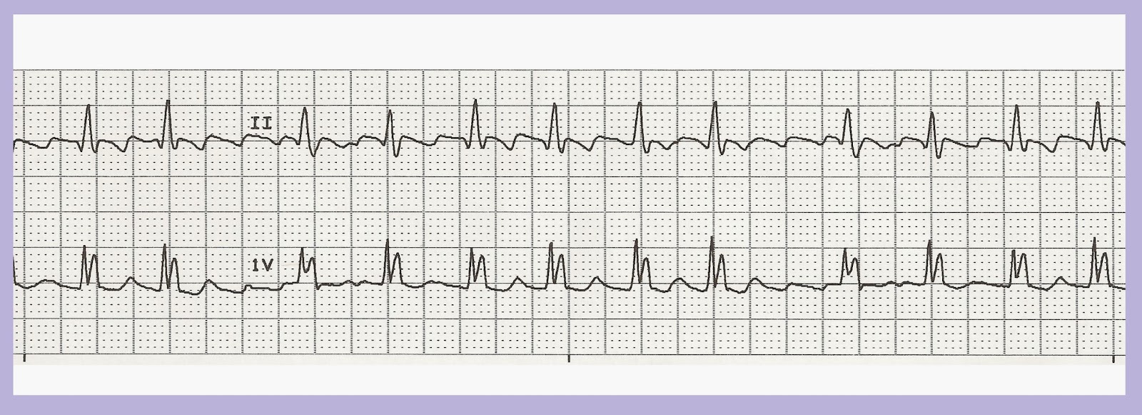 type ii atrial flutter icd 10 type ii atrial flutter icd 10