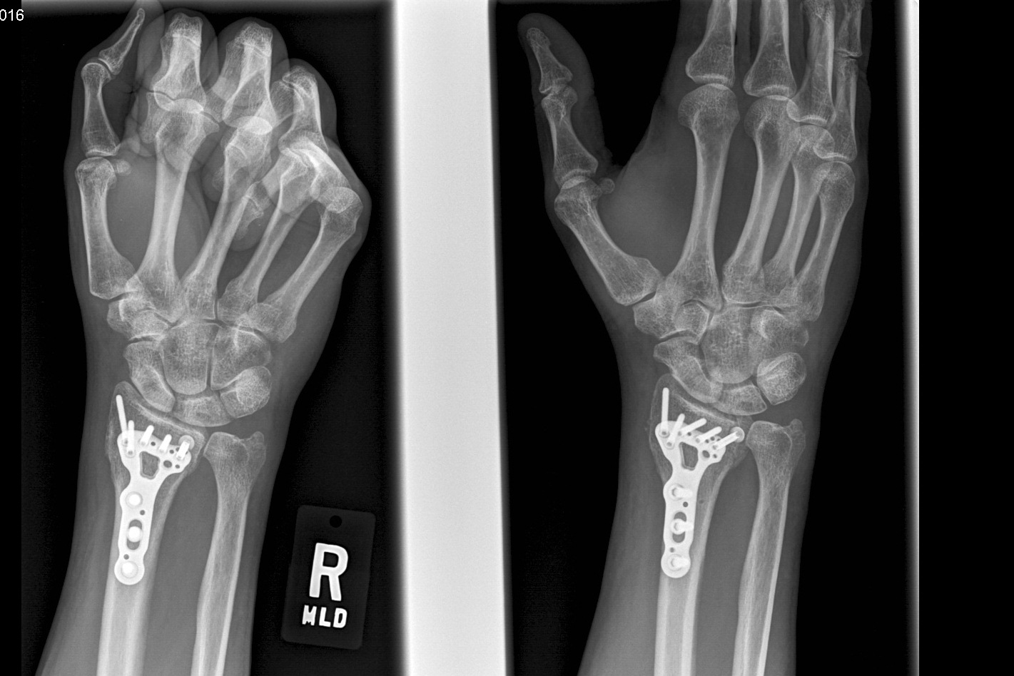 How To Type With A Broken Wrist