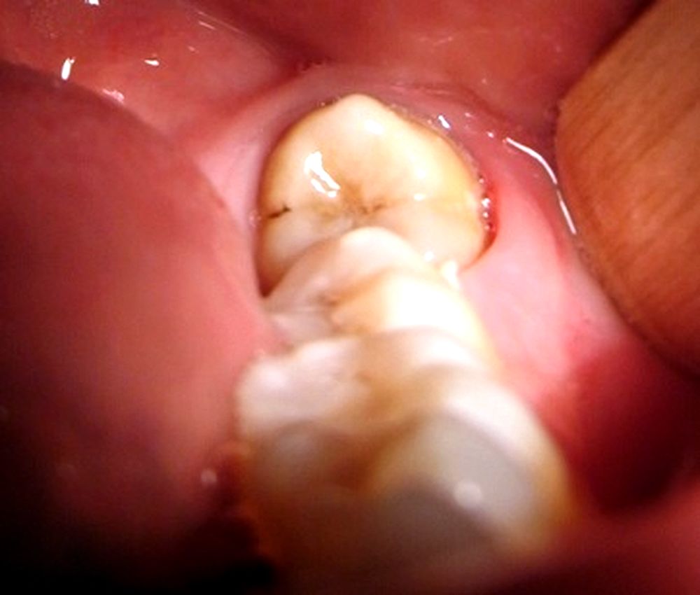 ¿Cual es la mejor edad para retirarse las muelas del juicio ? Directorio Odontológico ¿Cual es la mejor edad para retirarse las muelas del juicio ? Directorio Odontológico