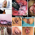 Ada Benjolan di Anus itu Kutil Kelamin atau Wasir thumbnail