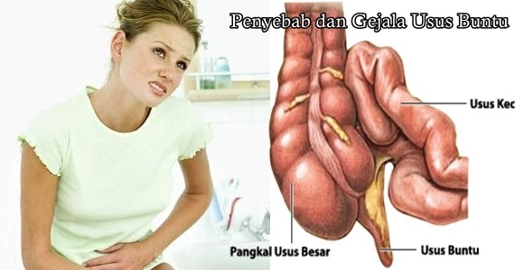 Ciri Ciri Penyakit Usus Buntu - Detik Kesehatan