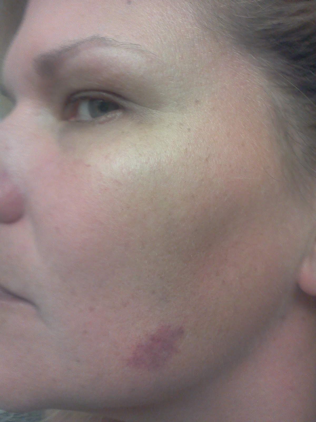 Life with Lupus Symptoms from mild to severe. These are just a few.