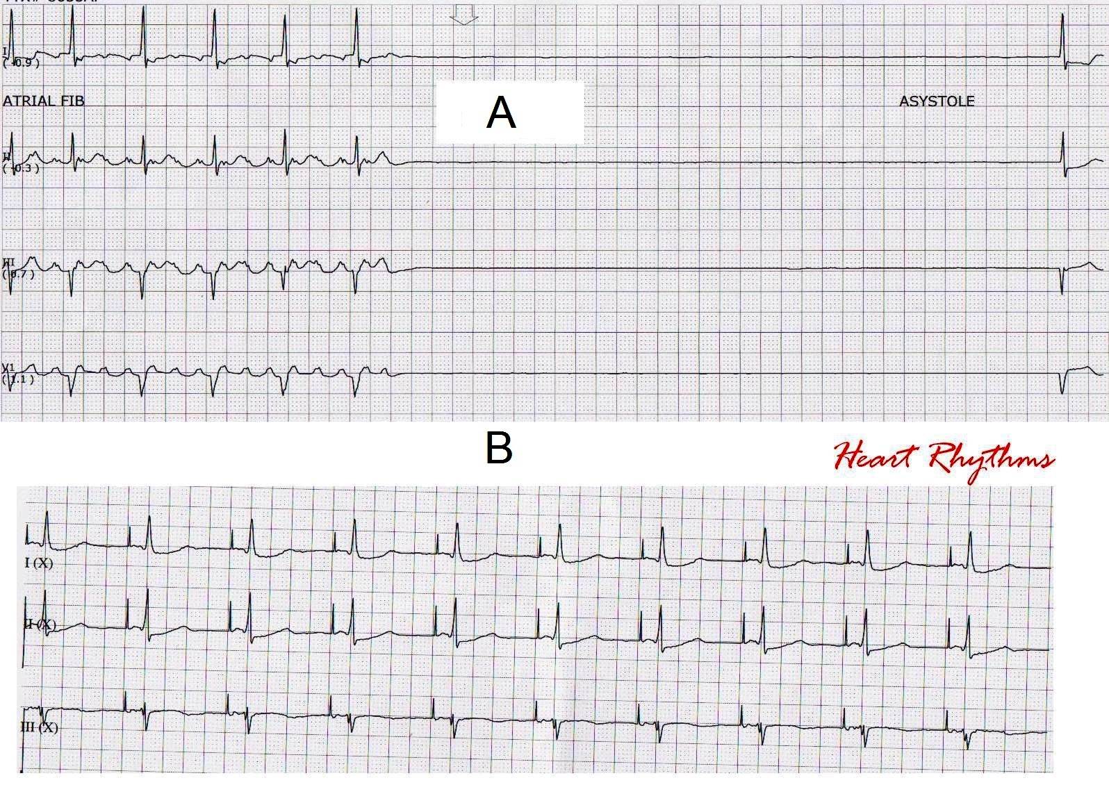 ECG Rhythms Telemetry captured the cause of syncope