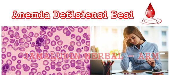 http://arumherbal30.blogspot.co.id/2018/01/cara-mengobati-anemia-defisiensi-besi.html