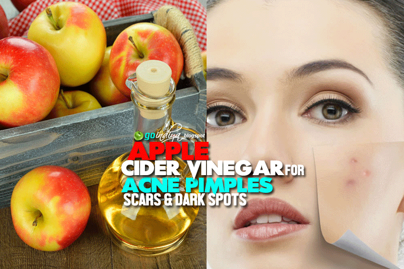 Apple Cider Vinegar for Acne, Pimples, Scars. 5 Ways to Use Apple Cider