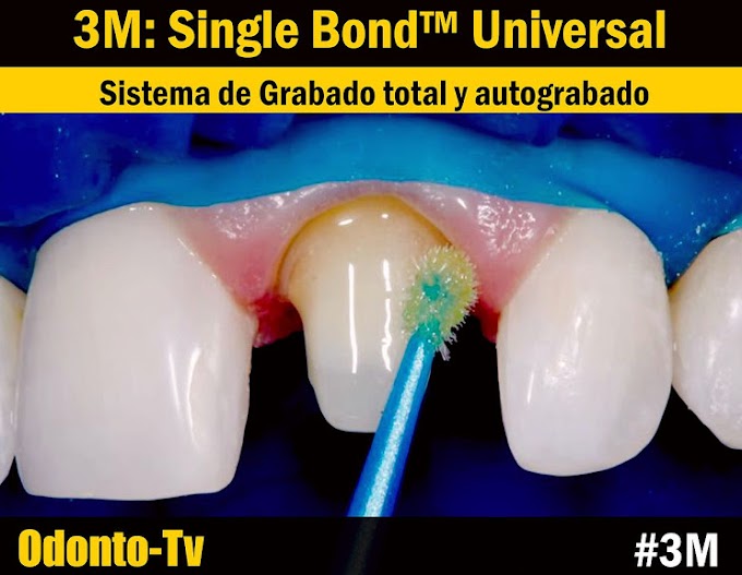 3M: Single Bond™ Universal - Sistema de Grabado total y autograbado
