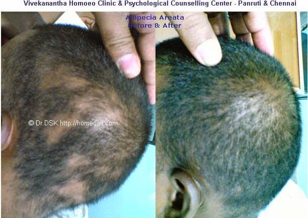  chennai alopecia areata clinic hospital velachery, tamil nadu, india doctor