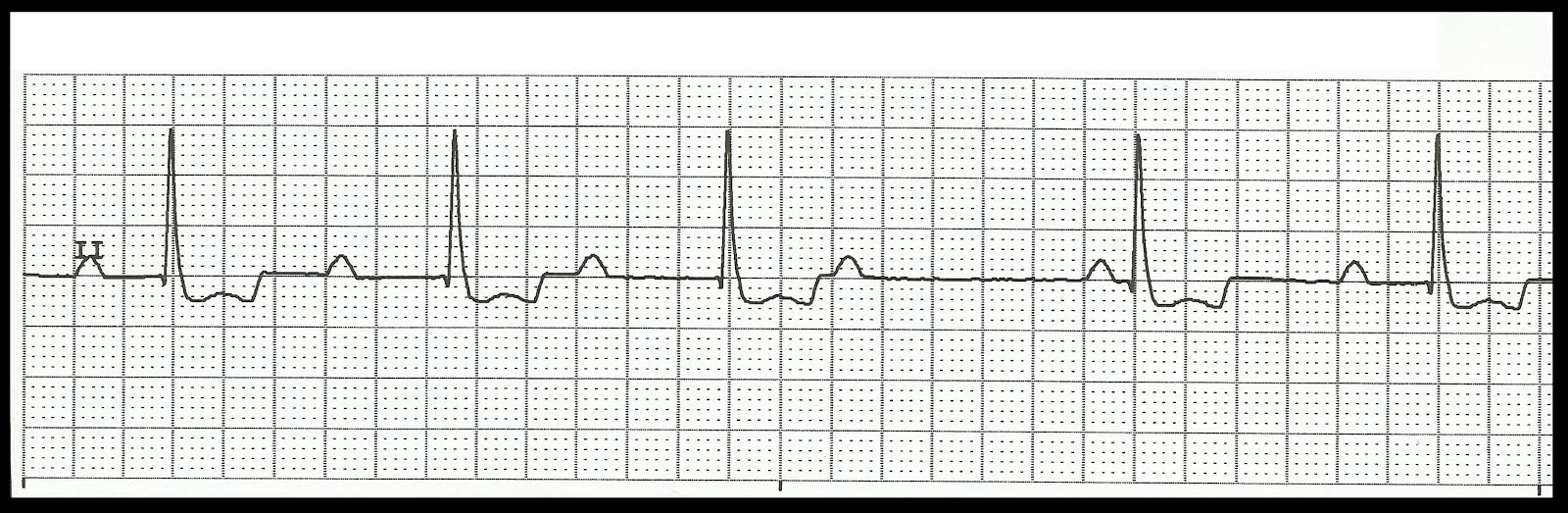 Float Nurse Practice EKG Rhythm Strips 178