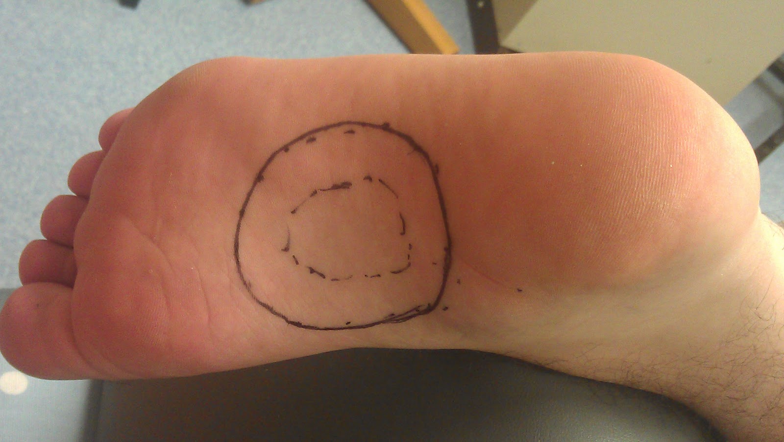 Ledderhose Disease Blog Radiotherapy for my plantar