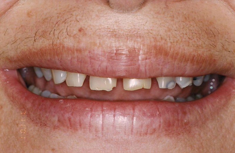 Orthofill Teeth gap band