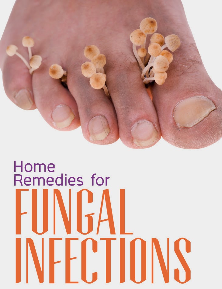 Home Remedies For Fungal Infections Tips Park