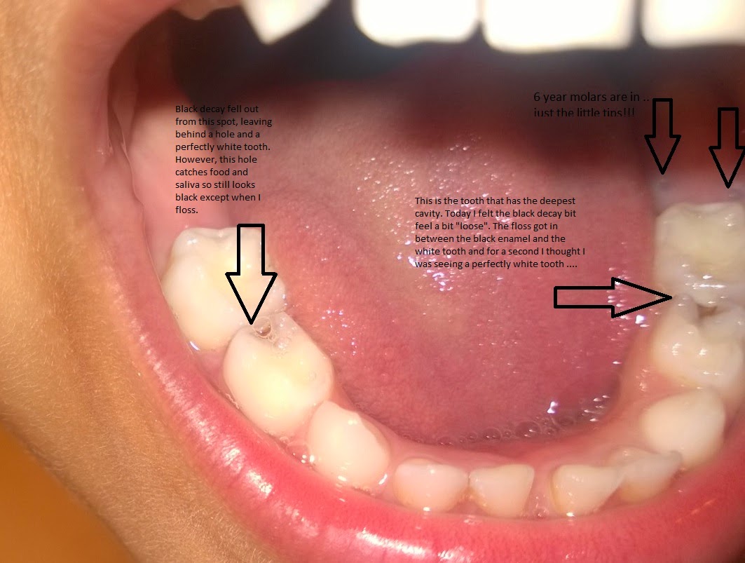 My attempt to remineralize teeth First permanent tooth is in and is the premolar getting