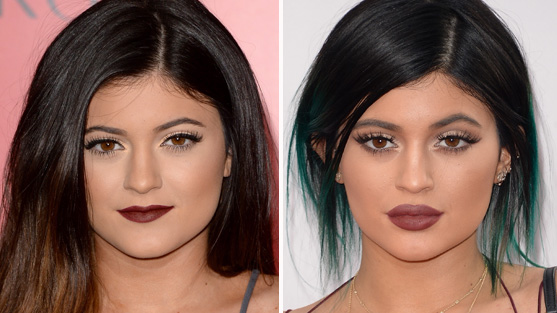 lip injecties voor en na