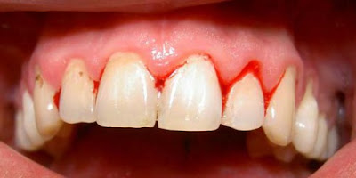 5 bí quyết chữa viêm chân răng bằng thuốc nam 1