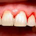 5 bí quyết chữa viêm chân răng bằng thuốc nam