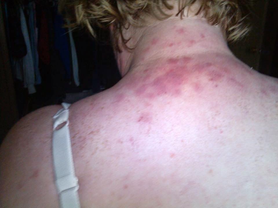 You're not crazy. you're sick My Lovely Discoid Lupus Pics