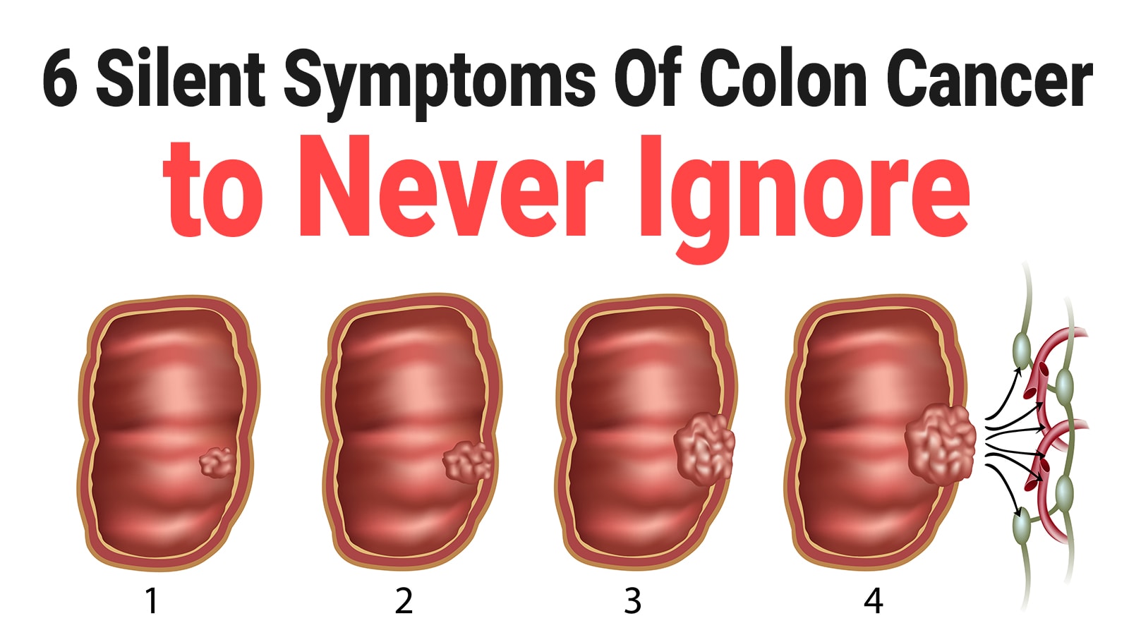 Silent Symptoms Of Colon Cancer To Never Ignore Health Queen
