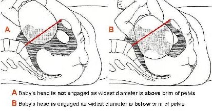 Walking with Dancers: Helping the Baby Engage at The End ... diagram of the fetal skull 