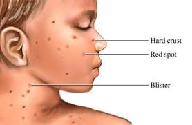 faudzil.blogspot.com: CHICKEN POX - All You Need to Know